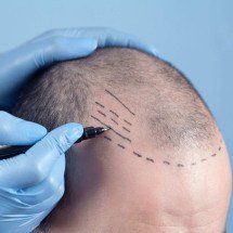 Tecnologia visa mais naturalidade em transplante capilares - DINO
