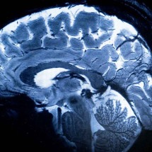 Um dos objetivos da campanha Maio Cinza é pressionar para mais acesso a exames de imagens pelo SUS -  (crédito: Alain JOCARD / AFP)