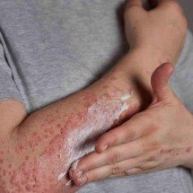 O que é dermatite atópica? SUS passa a oferecer tratamento para a doença - Freepik