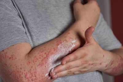 Doença não contagiosa, a dermatite atópica é uma condição genética -  (crédito: Freepik)