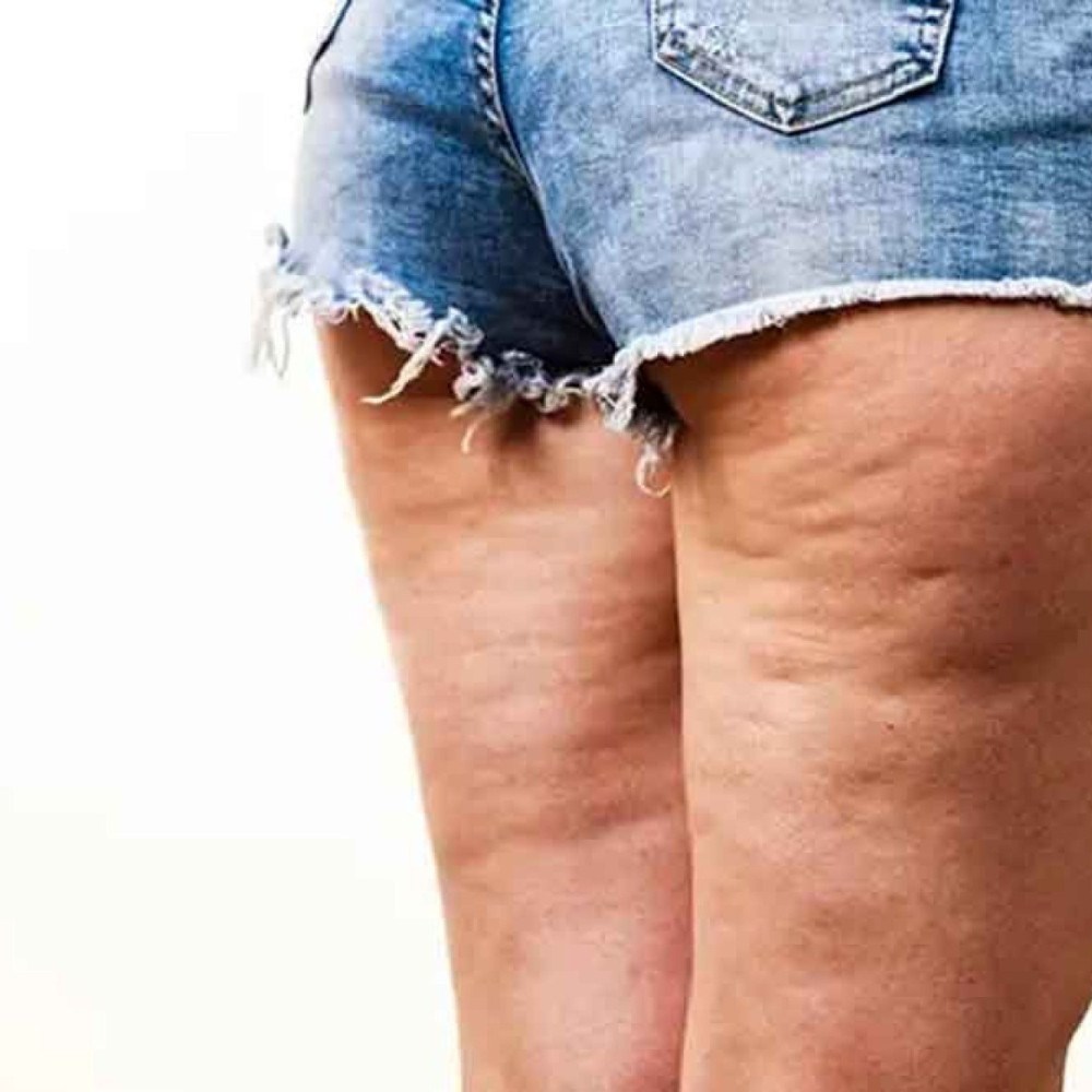 Mitos e verdades sobre a celulite