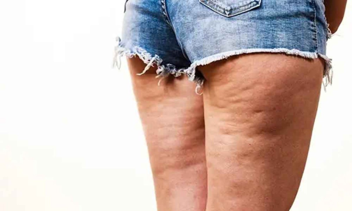 Celulite não é exclusividade de mulheres que estão acima do peso - (crédito: Divulgação) Celulite não é exclusividade de mulheres que estão acima do peso - (crédito: Divulgação)