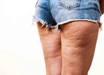 Celulite não é exclusividade de mulheres que estão acima do peso -  (crédito: Divulgação)