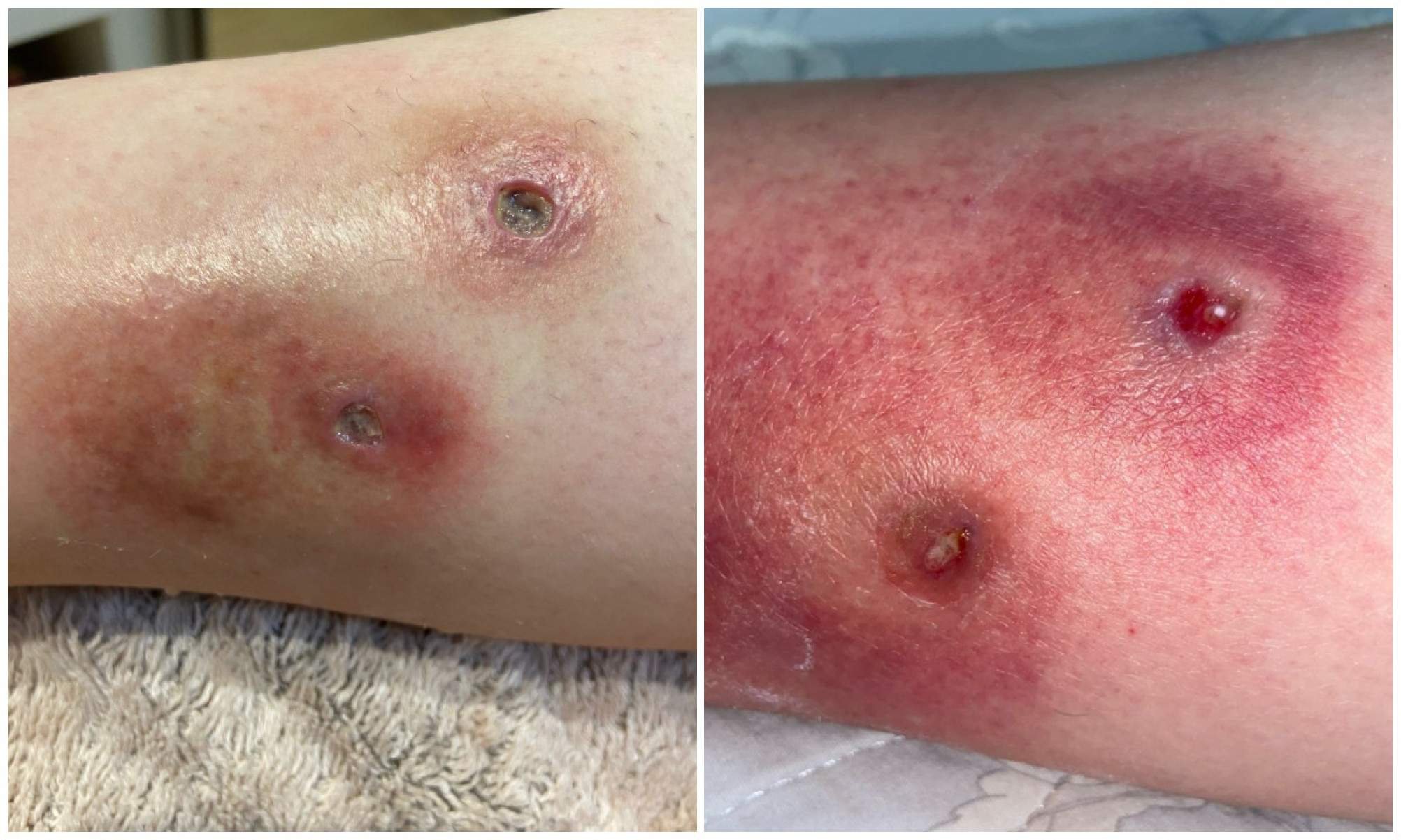 Imagens enviadas por Michele Fraga mostram como ficou sua perna após a mordida do animal