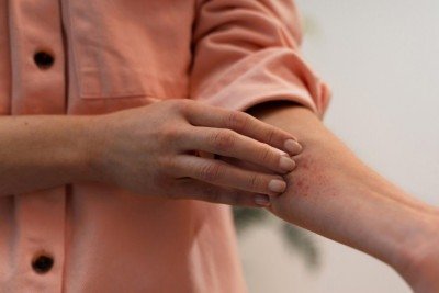 A dermatite atópica é uma doença não contagiosa, genética e crônica -  (crédito: Freepik)