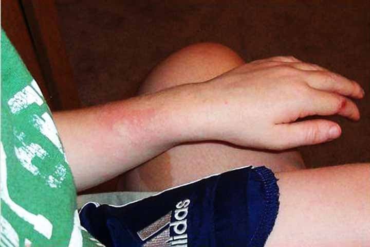 Ela pode manifestar-se com sintomas na pele (urticária, coceira), trato gastrointestinal (náuseas, vómitos) ou respiratório (dificuldade para respirar). 