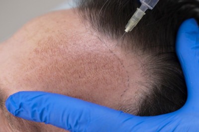 Comunicação transparente entre médico e paciente é essencial para garantir um transplante capilar seguro, eficaz e com resultados duradouros -  (crédito: Freepik)