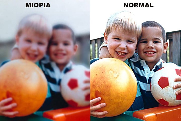 Atualmente, as lentes de contato são produzidas com materiais avançados, permitindo maior oxigenação dos olhos e adaptação personalizada para diferentes necessidades visuais. Elas são indicadas para diversas condições visuais, incluindo miopia, hipermetropia, astigmatismo e presbiopia.