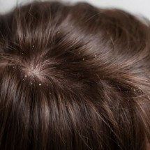Dicas para se livrar da caspa e da vergonha - Freepik