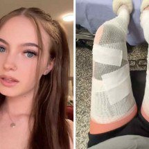 Influenciadora relata queimaduras graves após dia no sol sem proteção - Reprodução / TikTok