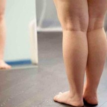 Fisioterapia ajuda no tratamento de lipedema - Freepik