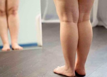 Médico ressalta que a presença de dor é o grande problema entre os que sofrem de lipedema 
 -  (crédito: Freepik)