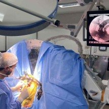 Santa Casa realiza mutirão de cirurgia cerebral em pacientes com Parkinson