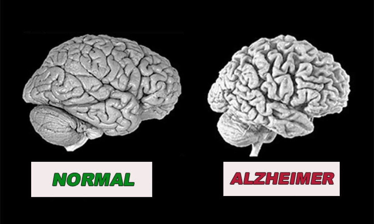 A dem&ecirc;ncia mais comum e famosa &eacute; a do Mal de Alzheimer. A doen&ccedil;a costuma aparecer no final da vida. Assim, muita gente a confunde com o processo de envelhecimento normal -  (crédito: Reprodu&ccedil;&atilde;o)