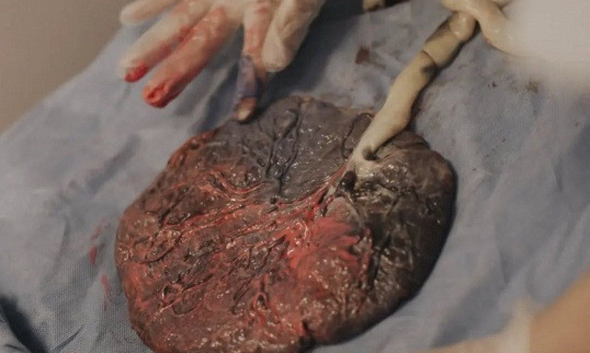 Arte na placenta 