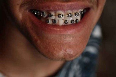 Segundo um estudo de 2024, publicado pela Dental Press Journal Orthodontics, 85,17% das crianças brasileiras entre 6 e 10 anos apresentam necessidade de algum tipo de intervenção ortodôntica -  (crédito: Bernardo Dantas / Revista Aurora / Diário de Pernambuco)