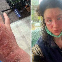 Mulher com abstinência de cremes relata dores extremas e rosto queimado - Reprodução / Redes sociais