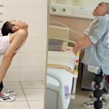 Após tratamento complexo, "menino dobrado" chinês consegue deitar pela 1ª vez - Reprodução/SCMP