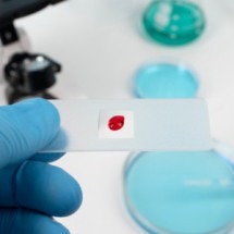 Câncer no sangue: estudo identifica proteínas envolvidas na imunoterapia