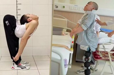 Um estudante chinês de 21 anos precisou passar por quatro cirurgias complexas para corrigir uma deformidade extrema na coluna. -  (crédito: Reprodução/SCMP)