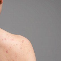 Espinhas nas costas: o que contribui para acnes nessa área do corpo - Freepik