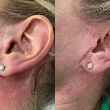 Tatuagem paramédica: técnica é utilizada para restaurar autoestima - Arquivo Pessoal/Divulgação 