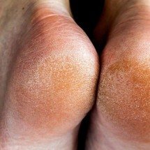 Rachaduras nos pés: descubra o que isso diz sobre sua saúde - Bilanol