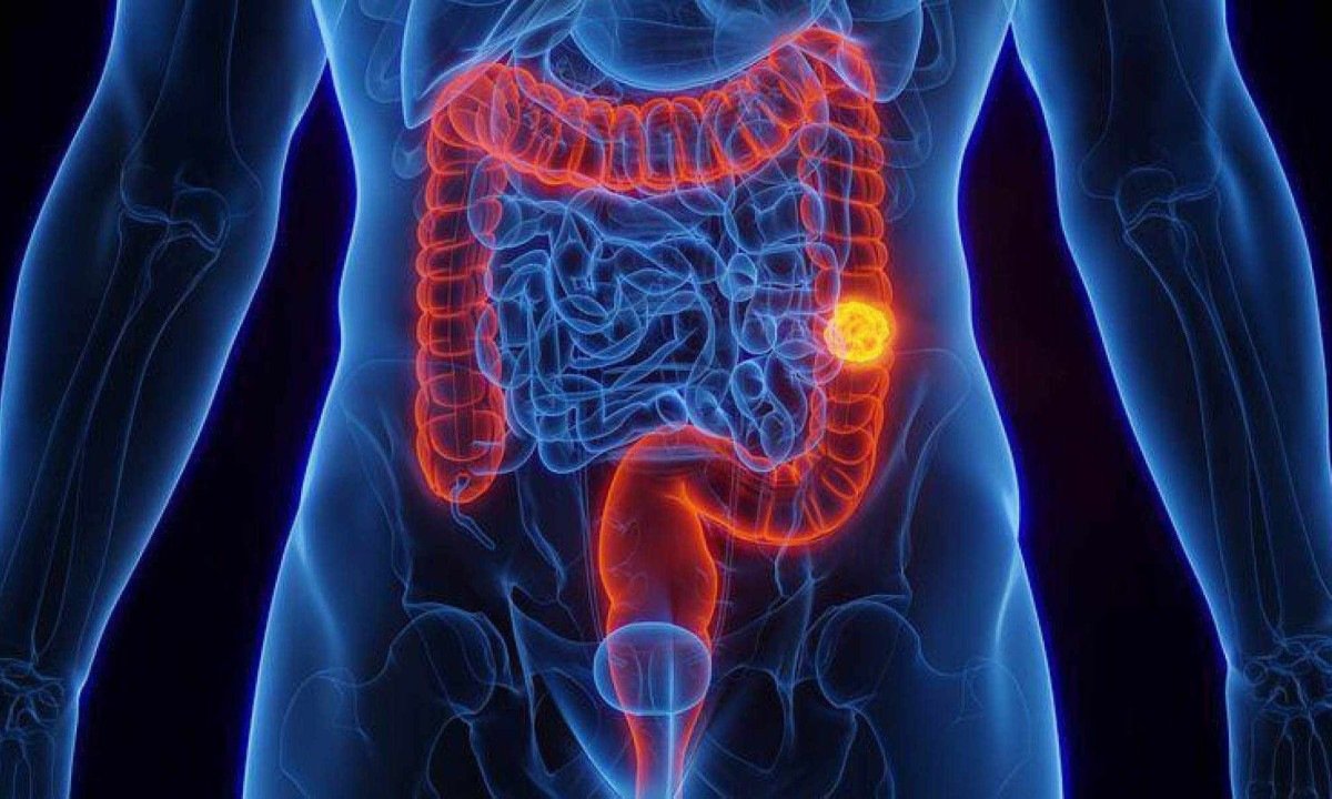 Mortalidade por câncer colorretal deve aumentar bastante no Brasil nos próximos anos, mostram projeções -  (crédito: Getty Images)