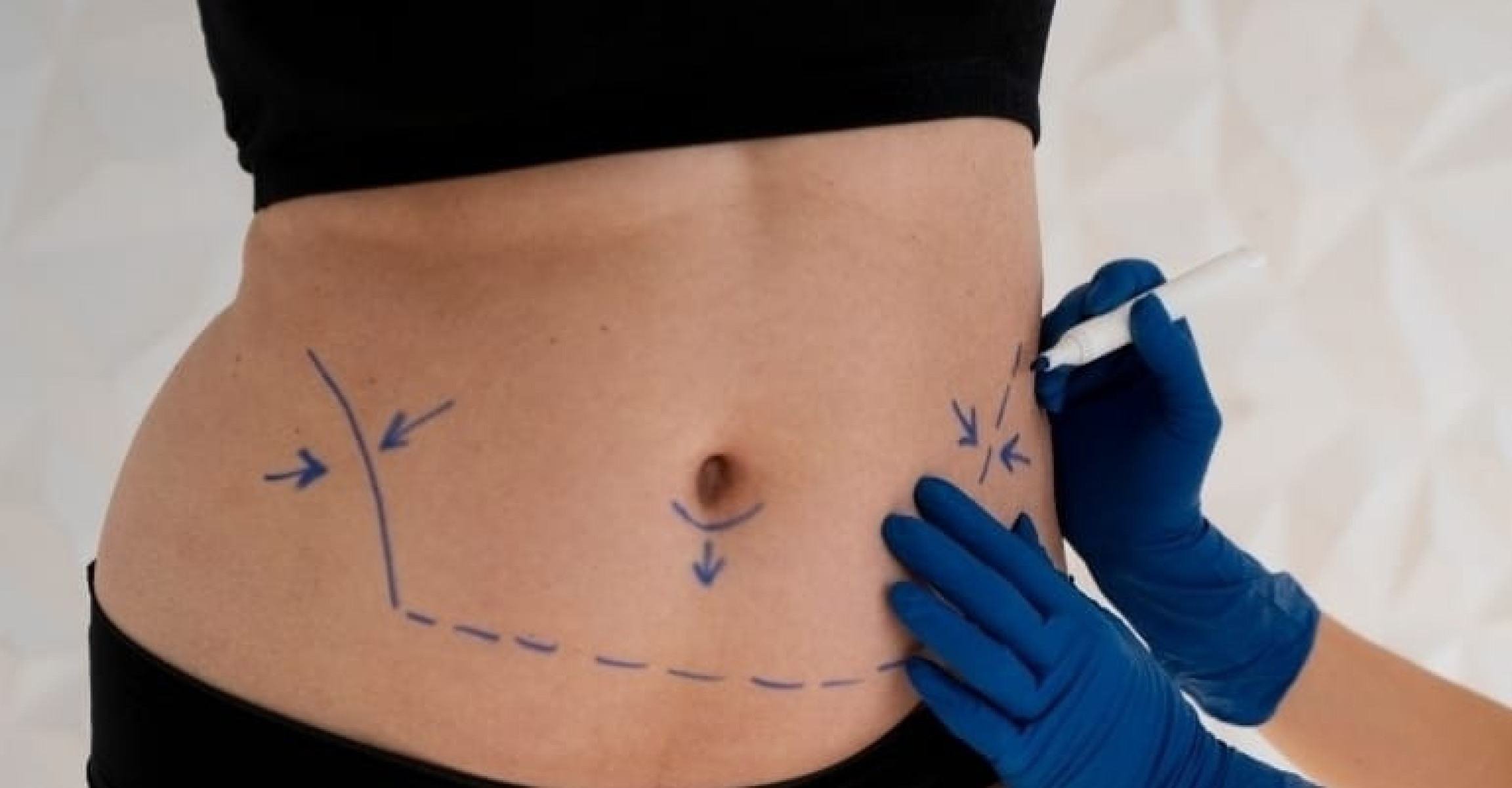 Mini ou abdominoplastia: especialista aponta melhor escolha - DINO