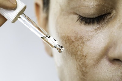 O melasma, muito comum no Brasil e especialmente em mulheres, nÃ£o tem cura definitiva, mas tem controle     -  (crédito: FreePik)