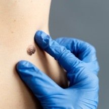 Identificados genes que podem prever resposta de pacientes com melanoma  - Freepik)