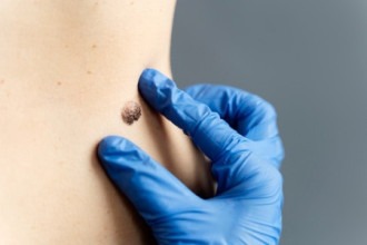 Identificados genes que podem prever resposta de pacientes com melanoma 