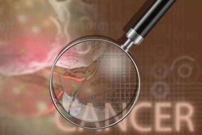 O processo de formação do câncer é chamado de carcinogênese e normalmente ocorre lentamente, podendo levar vários anos para que uma célula cancerosa prolifere e dê origem a um tumor visível
 -  (crédito: Invitrocue Brasil/Divulgação)