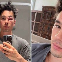 Jovem ignora espinha e viraliza com cisto grave que quase desfigurou rosto - Reprodução / TikTok