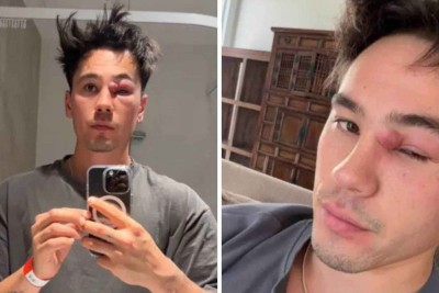  Kai Davidson buscou ajuda médica depois que cisto começou a aumentar de tamanho -  (crédito: Reprodução / TikTok)