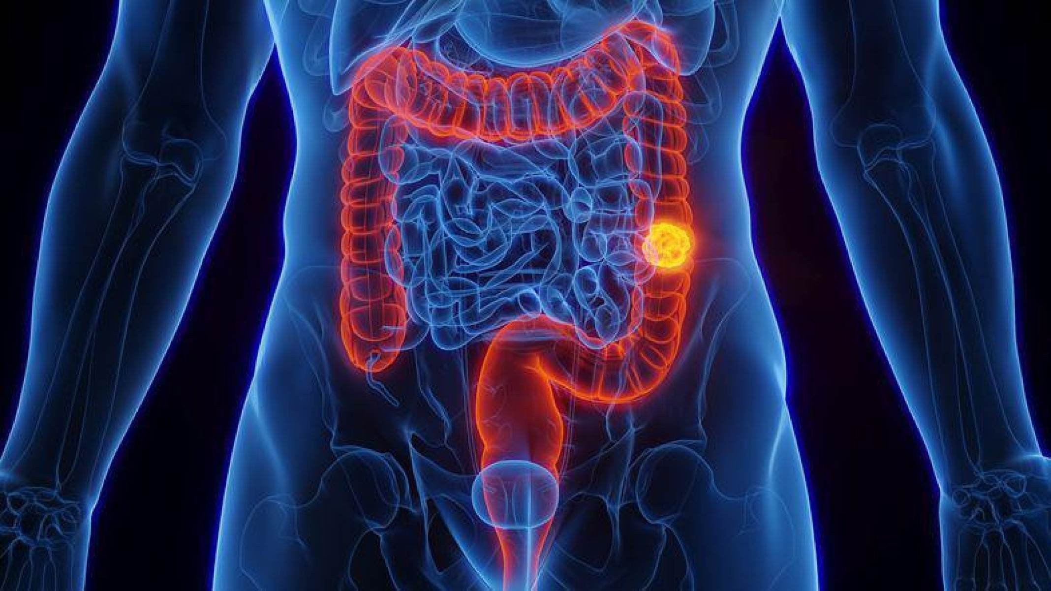 Estudo aponta maior agressividade de tumor colorretal em adultos jovens - Getty Images
