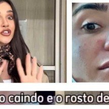 Complicação no seio após anabolizante: entenda o caso de Giselly Bicalho - Reprodução/Redes Sociais