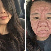 Mulher expõe mudanças drásticas na pele durante gravidez - Reprodução / redes sociais