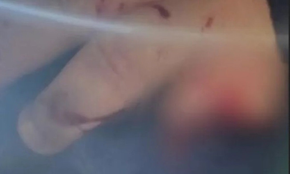 No hospital, ele levou 15 pontos e não foi possível reimplantar o dedo amputado  -  (crédito: Imagem/Divulgação)