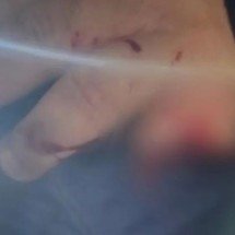 MG: homem tem dedo decepado após tropeçar em cercadinho de árvore - Imagem/Divulgação