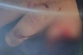 MG: homem tem dedo decepado após tropeçar em cercadinho de árvore