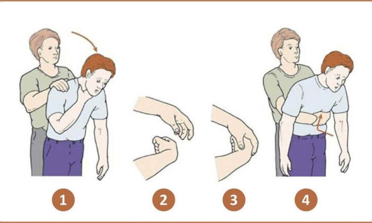 Manobra de Heimlich