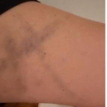 Atriz fica com estranhos hematomas durante gravações de filme de terror - Foto: Print Portal do Medo