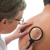 Como identificar uma pinta maligna?