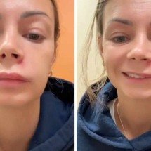 Mulher espreme espinha no ‘triângulo da morte’ e vai parar no hospital - Reprodução / TikTok