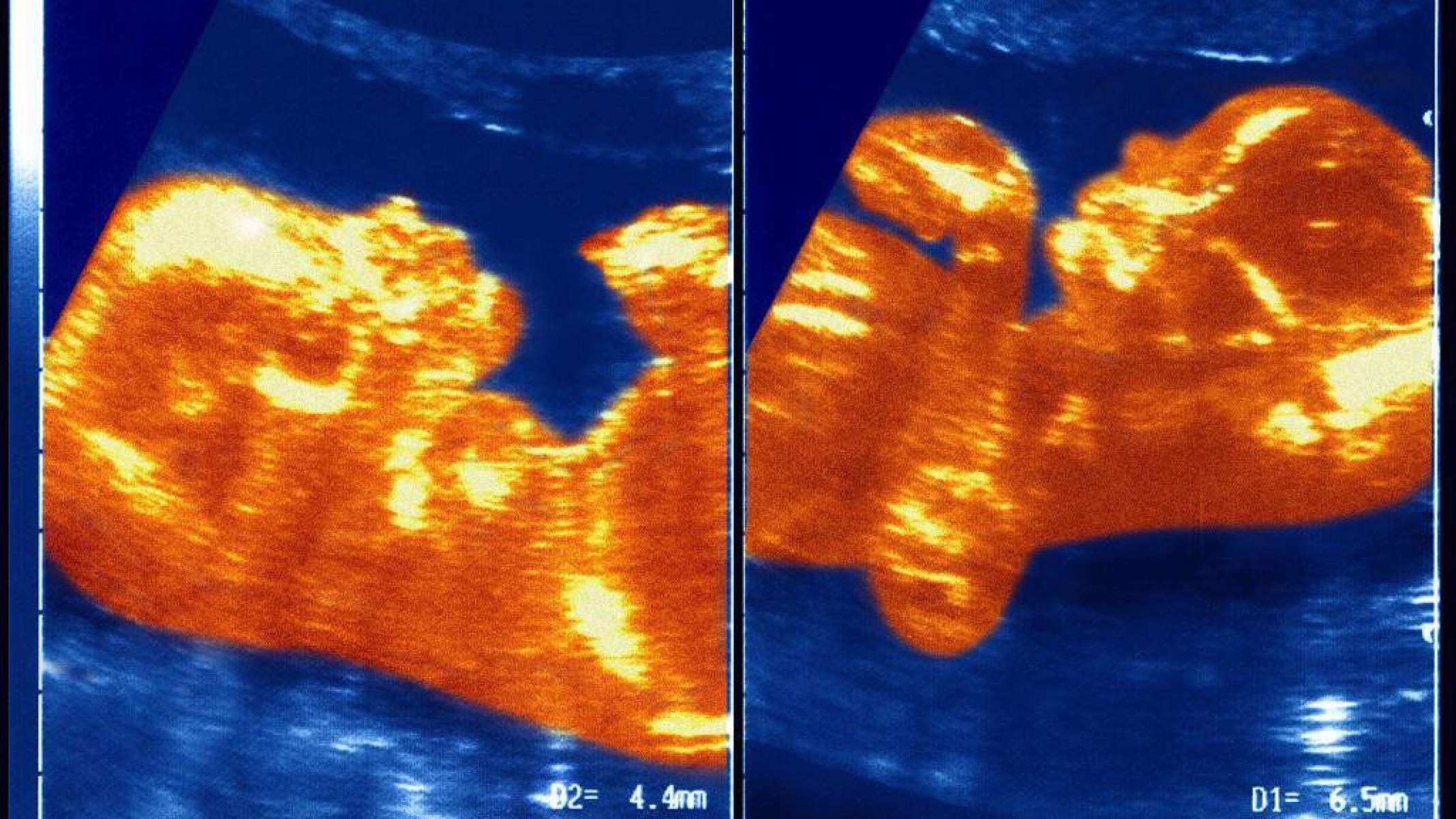 O caso inédito da brasileira que carrega DNA do irmão gêmeo