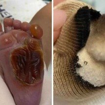 Bebê sofre queimadura grave no pé em hospital horas depois do parto - Reprodução / Instagram