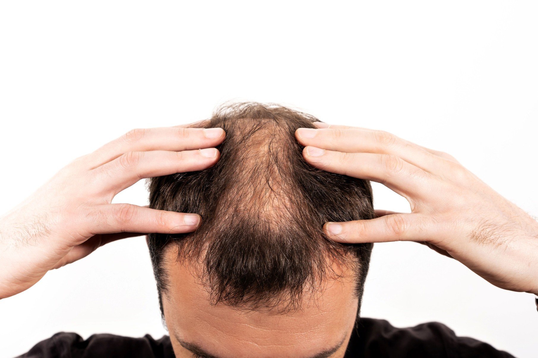 Alopecia: técnicas de tricologia podem oferecer soluções - DINO