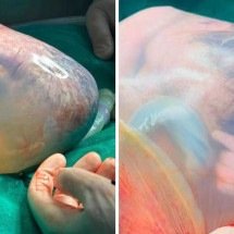 Hospital registra dois nascimentos raros de bebês empelicados em 48 horas -  Hospital Marieta Konder Bornhausen