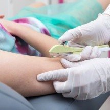 Implante contraceptivo hormonal passa a ser oferecido pelo SUS - Cofen/Reprodução